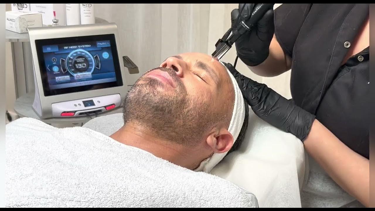 RF Need – Revoluția tratamentului de rejuvenare facială și corporală - DermaLux Iasi