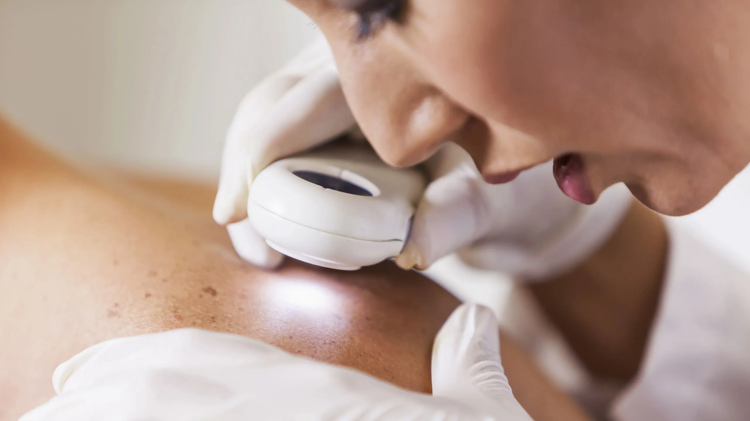 Tratamentul hiperpigmentărilor - Cum să tratezi melasma eficient - DermaLux Iasi